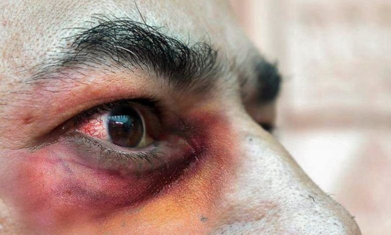 Ahora en Oaxaca: Detectan dos posibles casos de “hongo negro” 25hongo-negro-oaxaca-dos-casos-registrados-1-780x470