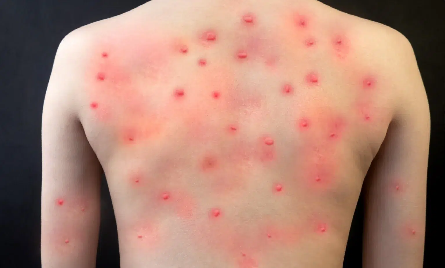 viruela-mono-ninos-1536x925