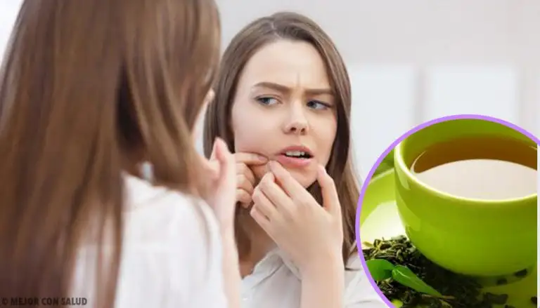 6-formas-de-emplear-el-té-verde-contra-el-acné-768x439
