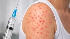 Casos de sarampión en México: Estas son las medidas que tomará la Secretaría de Salud