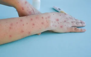 Contagios de sarampión y la temporada de mayor riesgo sanitario 