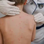 Salud confirma 8,000 casos de sarampión y 27 muertes a un año del brote-1