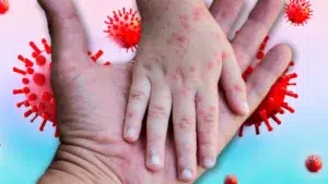 Sarampión: una enfermedad altamente contagiosa que sigue siendo una amenaza para niños y adultos