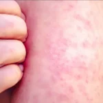 sarampion-pese-a-vacuna-que