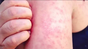 México cierra segunda semana de febrero con 9 mil 478 casos de sarampión; suman 29 defunciones