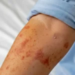 sarampion-reaparece-puebla-anos-reportar