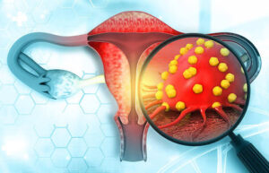Instituto Nacional de Cancerología avanza en tratamiento de cáncer cervicouterino y mamario durante el embarazo.